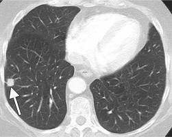 Chest CT